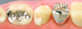足立区綾瀬の歯医者　新井歯科医院　インレー（写真左）、クラウン（写真右)