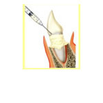 足立区綾瀬の歯医者　新井歯科医院　歯周病治療　歯周外科処置（歯周組織再生療法）