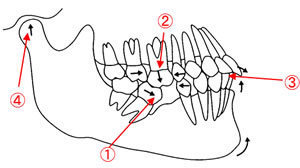 足立区綾瀬の歯医者　新井歯科医院　インプラント　失った歯を放置すると出る障害