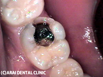 足立区綾瀬の歯医者　新井歯科医院　他医院での詰め物が取れ、神経まで達している重度の虫歯（C3）となっています。
