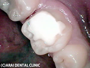足立区綾瀬の歯医者　新井歯科医院　歯の形を整え、型を取ります。