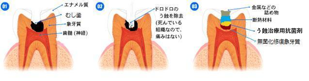 綾瀬の歯医者、新井歯科医院が、神経を抜かない治療にこだわる理由