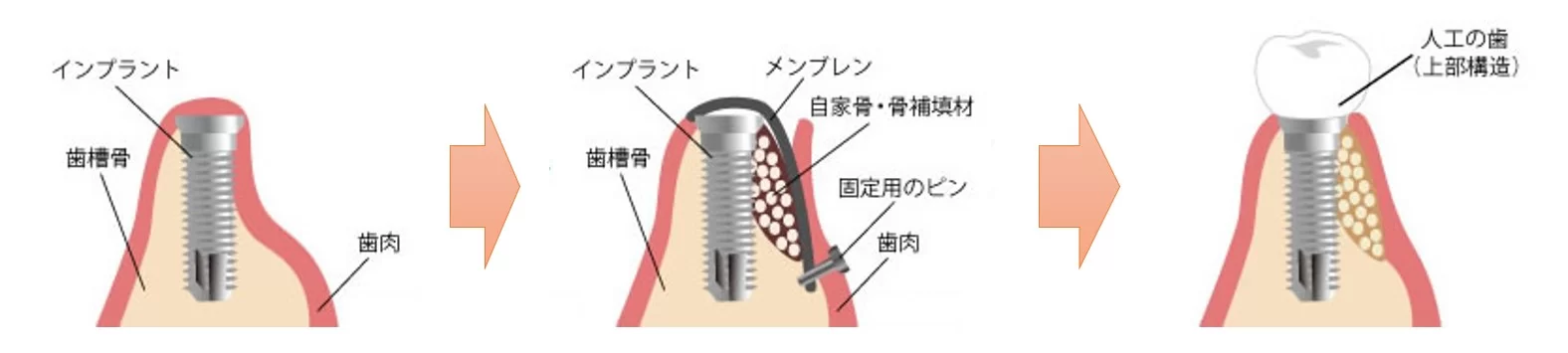 綾瀬の歯医者、新井歯科医院のインプラント治療