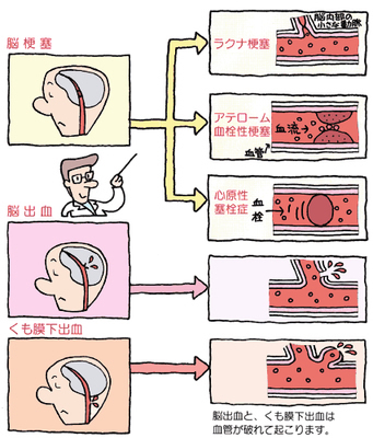 足立区綾瀬の歯医者 新井歯科医院 むし歯菌と脳卒中との関連が明らかに