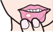 口内炎